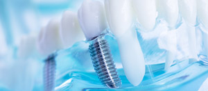 Missing Teeth Don’t Have to Be Lost Forever Missing Teeth Don’t Have to Be Lost Forever