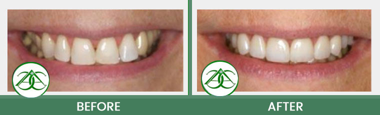 Crowns (Caps) at Allure Dental Center in Mountain View, CA