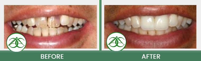Crowns (Caps) at Allure Dental Center in Mountain View, CA