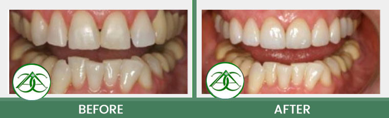 Crowns (Caps) at Allure Dental Center in Mountain View, CA