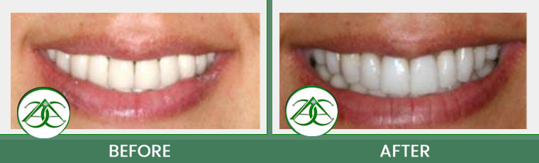 Crowns (Caps) at Allure Dental Center in Mountain View, CA