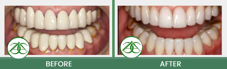 Porcelain Crowns (Caps) at Allure Dental Center in Mountain View, CA