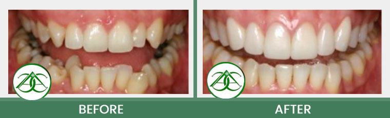 Crowns (Caps) at Allure Dental Center in Mountain View, CA