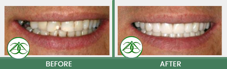 Crowns (Caps) at Allure Dental Center in Mountain View, CA