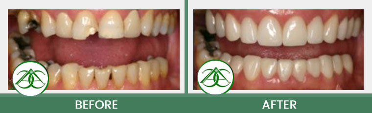 Crowns (Caps) at Allure Dental Center in Mountain View, CA