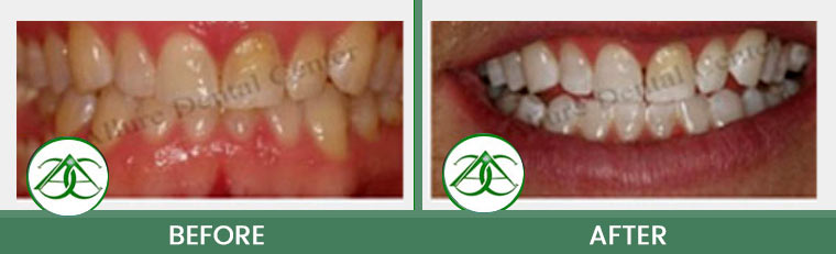 Deep Bleaching/Whitening at Allure Dental Center in Mountain View, CA