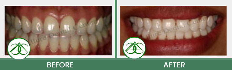 Deep Bleaching/Whitening at Allure Dental Center in Mountain View, CA