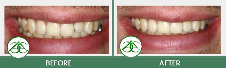 Dental Bonding at Allure Dental Center in Mountain View, CA