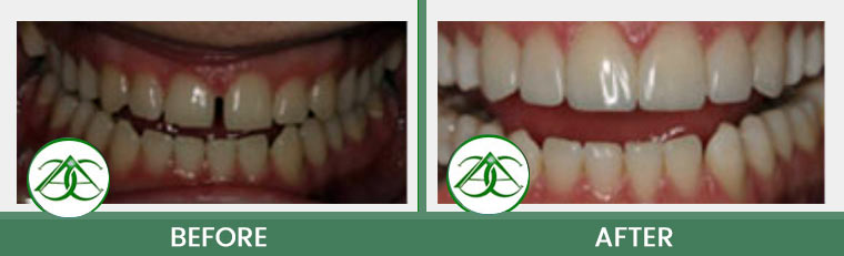 Dental Bonding at Allure Dental Center in Mountain View, CA