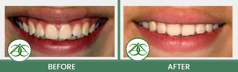 Dental Bonding at Allure Dental Center in Mountain View, CA