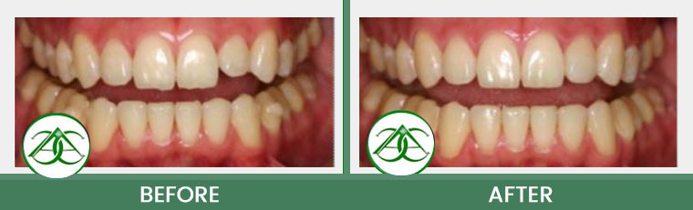 Dental Bonding at Allure Dental Center in Mountain View, CA