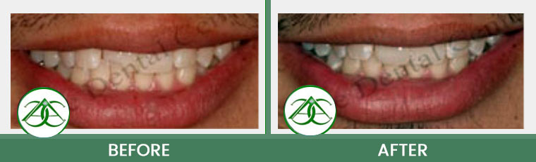 Dental Bonding at Allure Dental Center in Mountain View, CA