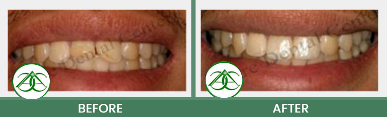 Dental Bonding at Allure Dental Center in Mountain View, CA