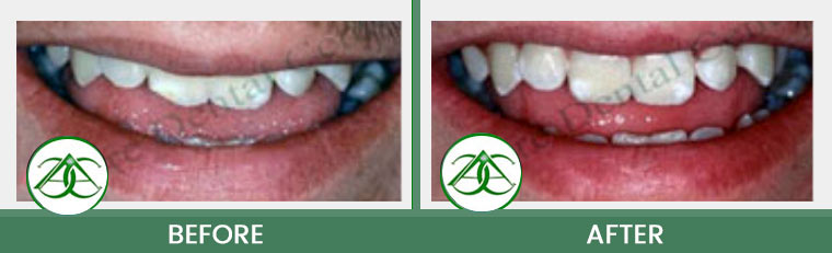 Dental Bonding at Allure Dental Center in Mountain View, CA