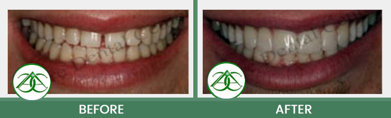 Dental Bonding at Allure Dental Center in Mountain View, CA