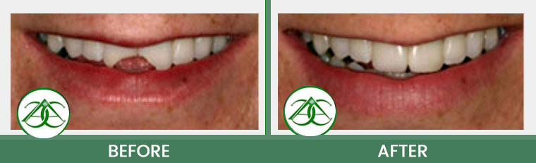 Dental Bonding at Allure Dental Center in Mountain View, CA
