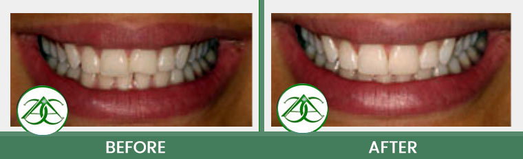 Dental Bonding at Allure Dental Center in Mountain View, CA