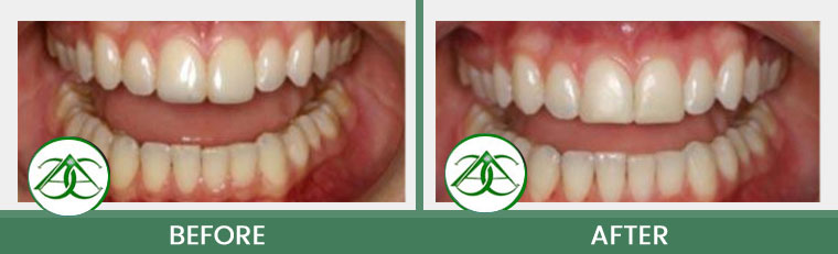 Dental Bonding at Allure Dental Center in Mountain View, CA