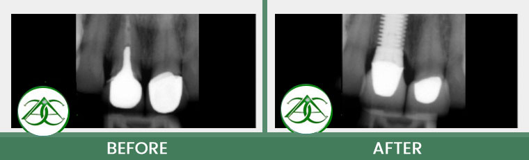 Dental Implants at Allure Dental Center in Mountain View, CA