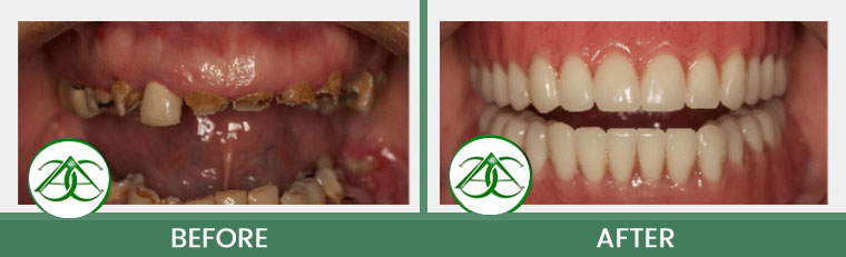 Dental Implants at Allure Dental Center in Mountain View, CA