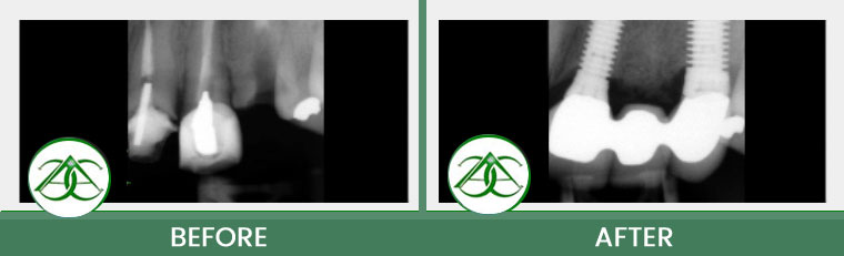 Dental Implants at Allure Dental Center in Mountain View, CA