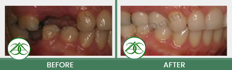 Dental Implants at Allure Dental Center in Mountain View, CA