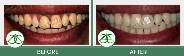 Dental Implants at Allure Dental Center in Mountain View, CA