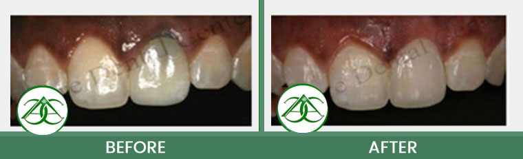 Dental Implants at Allure Dental Center in Mountain View, CA