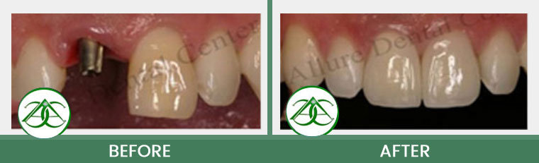 Dental Implants at Allure Dental Center in Mountain View, CA