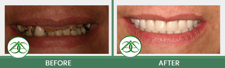 Dental Implants at Allure Dental Center in Mountain View, CA