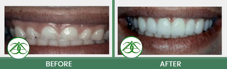 Gum Lifts/Contour at Allure Dental Center in Mountain View, CA