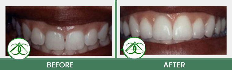 Gum Lifts/Contour at Allure Dental Center in Mountain View, CA