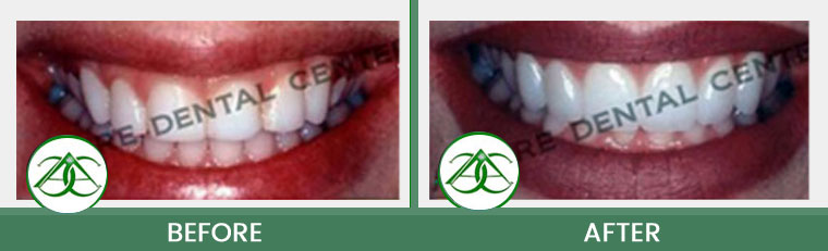 Gum Lifts/Contour at Allure Dental Center in Mountain View, CA