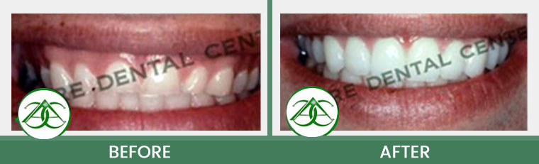 Gum Lifts/Contour at Allure Dental Center in Mountain View, CA