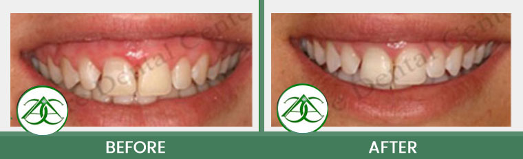 Gum Lifts/Contour at Allure Dental Center in Mountain View, CA