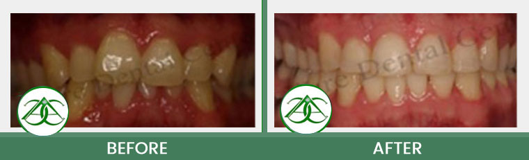 Orthodontics/Invisalign at Allure Dental Center in Mountain View, CA