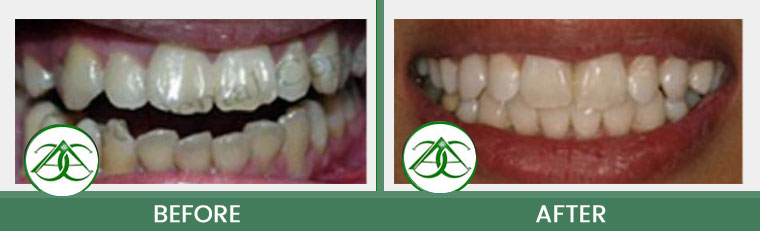Orthodontics/Invisalign at Allure Dental Center in Mountain View, CA