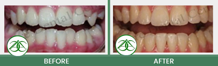 Orthodontics/Invisalign at Allure Dental Center in Mountain View, CA