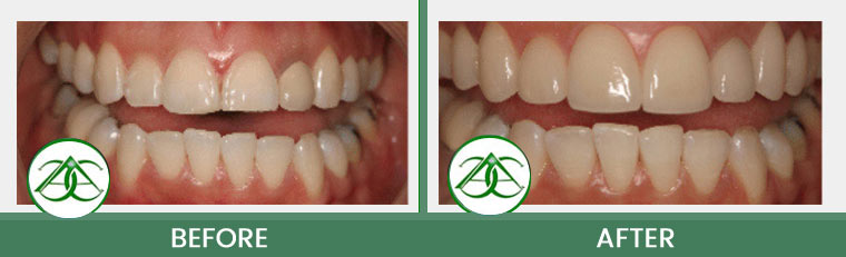 Porcelain Crowns (Caps) at Allure Dental Center in Mountain View, CA