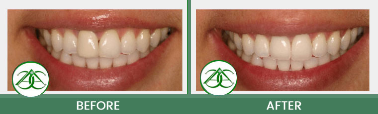 Porcelain Crowns (Caps) at Allure Dental Center in Mountain View, CA