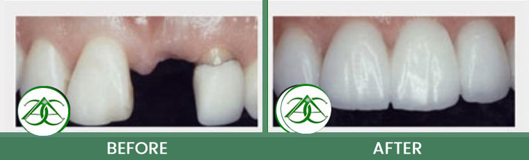 Porcelain Fixed Bridges at Allure Dental Center in Mountain View, CA