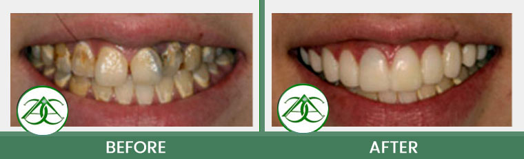 Porcelain Veneers at Allure Dental Center in Mountain View, CA
