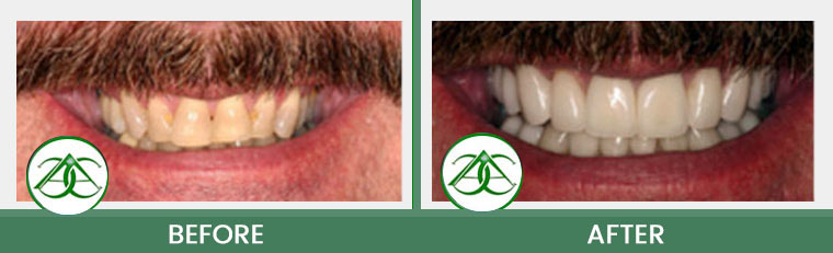 Porcelain Veneers at Allure Dental Center in Mountain View, CA