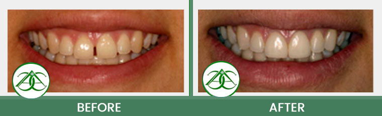 Porcelain Veneers at Allure Dental Center in Mountain View, CA