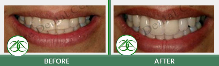 Porcelain Veneers at Allure Dental Center in Mountain View, CA