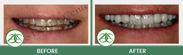 Porcelain Veneers at Allure Dental Center in Mountain View, CA