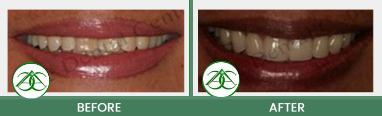 Porcelain Veneers at Allure Dental Center in Mountain View, CA