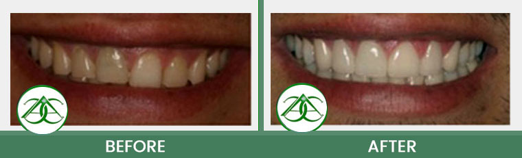 Porcelain Veneers at Allure Dental Center in Mountain View, CA