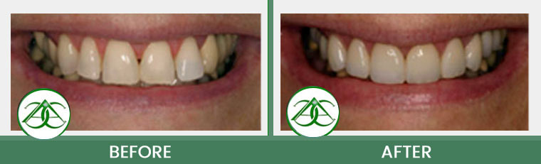 Porcelain Veneers at Allure Dental Center in Mountain View, CA