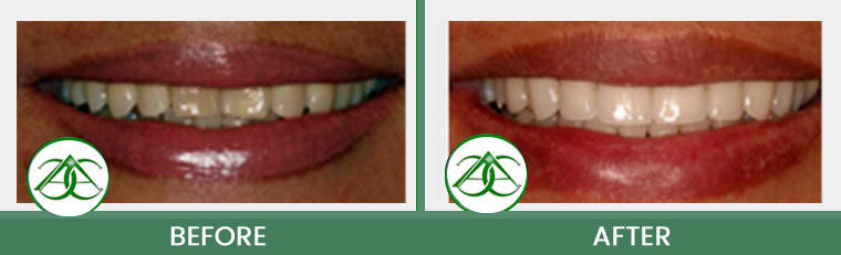 Porcelain Veneers at Allure Dental Center in Mountain View, CA